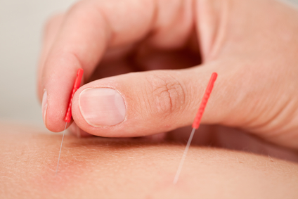 Acupuncture for low back pain