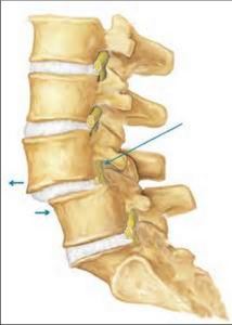 Spondlylolithesis 1