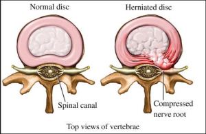 Verterbral disks