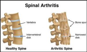 spinal arthritis