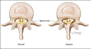 spinal stenosis